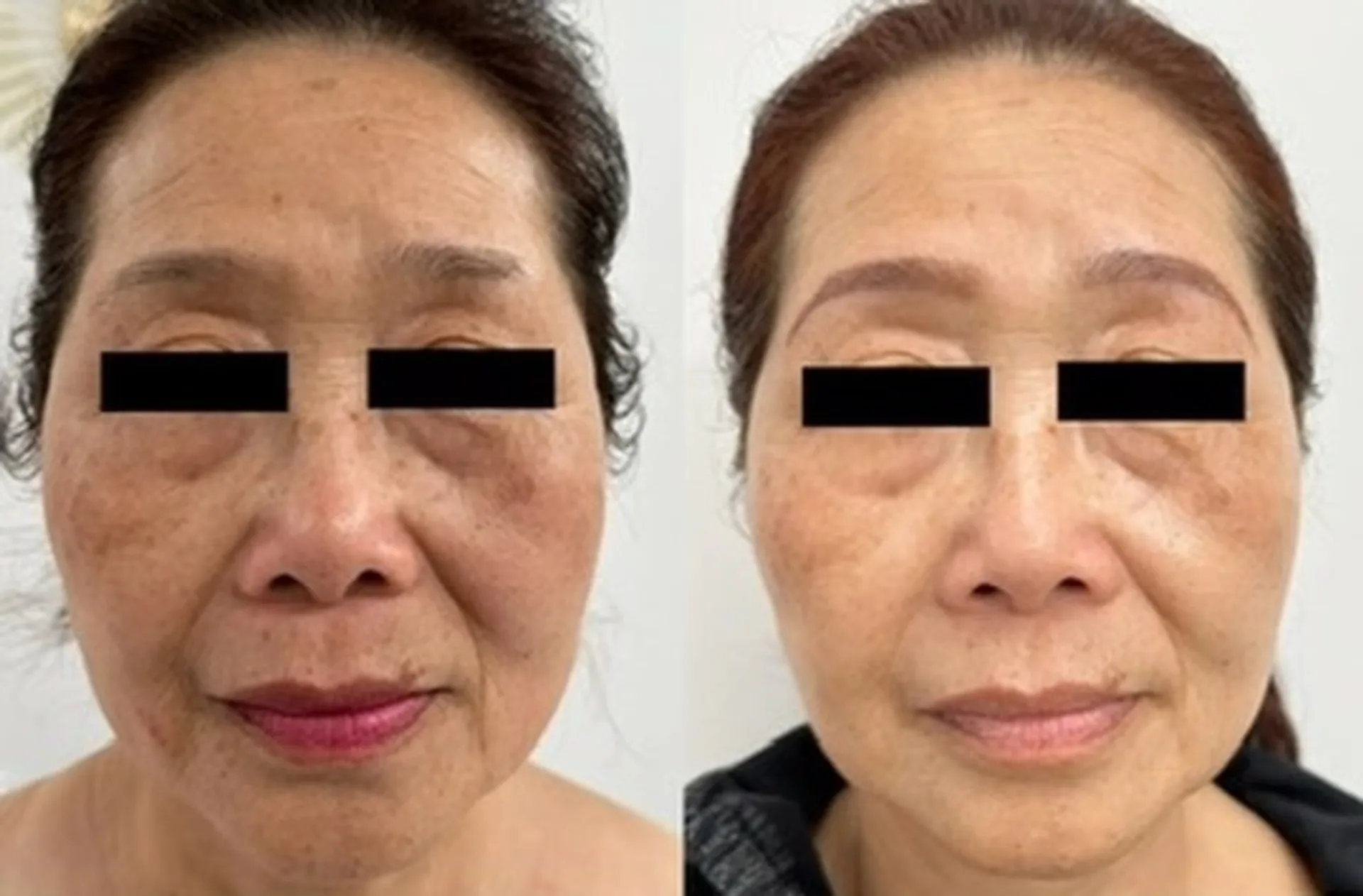 Résultat avant/après traitement anti-âge du visage - amélioration visible des taches pigmentaires et de la texture de la peau