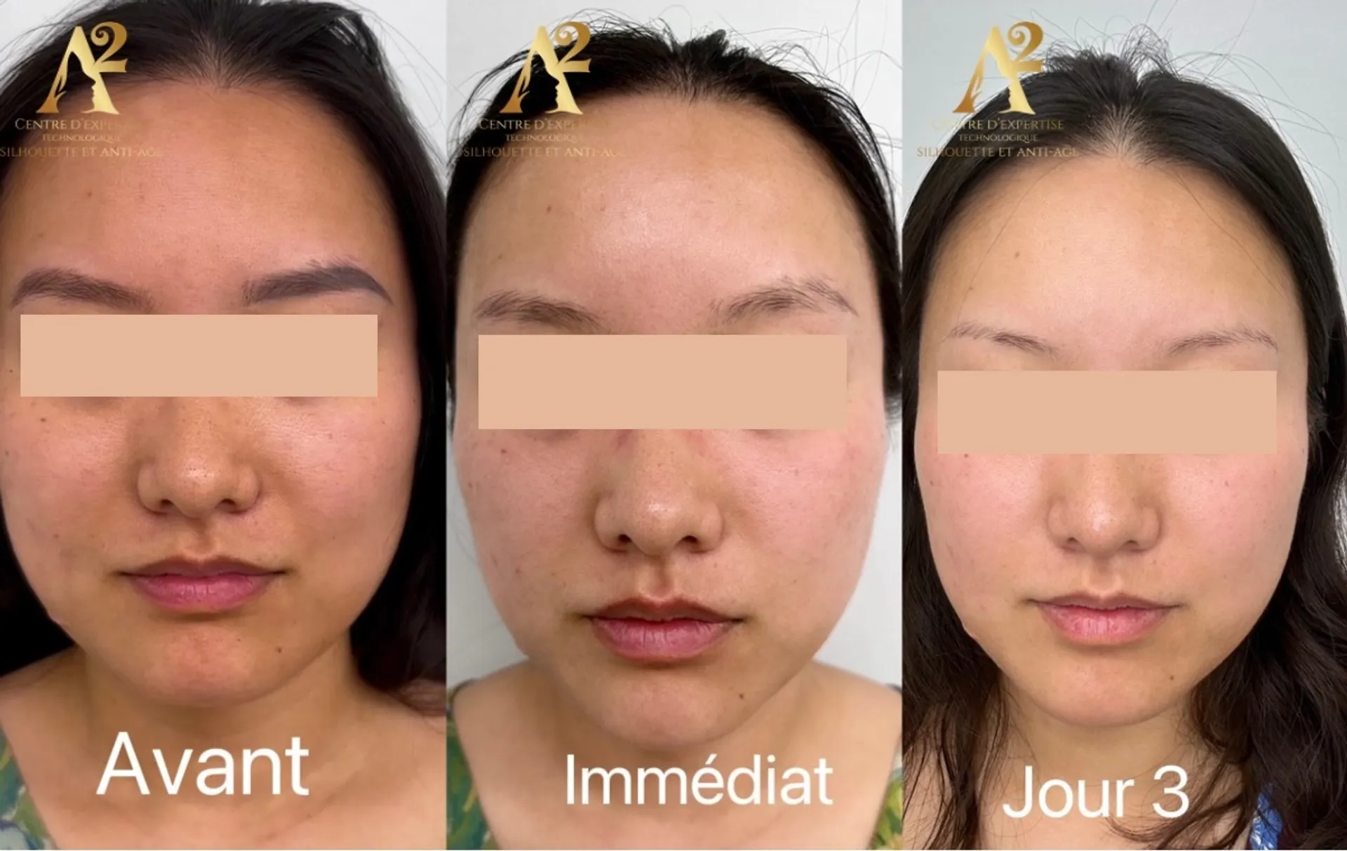 Résultat avant/après traitement anti-âge - exemple client 5