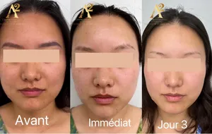 Résultat avant/après traitement anti-âge - exemple client 5