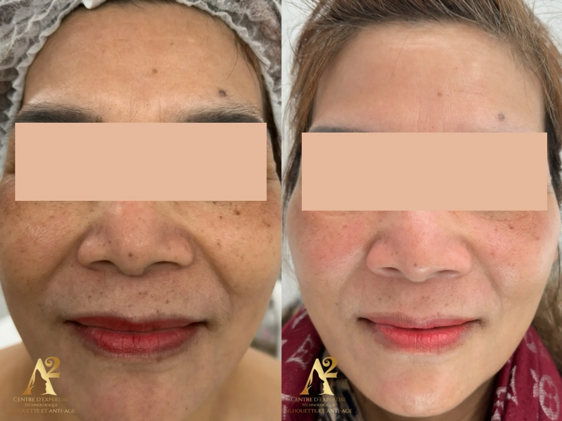 Résultat avant/après traitement anti-âge - exemple client 6