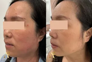 Résultat avant/après traitement anti-âge - exemple client 7