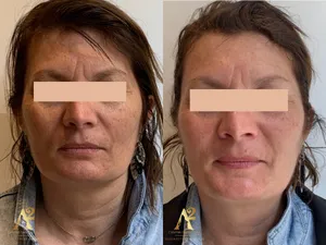 Résultat avant/après traitement anti-âge - exemple client 9